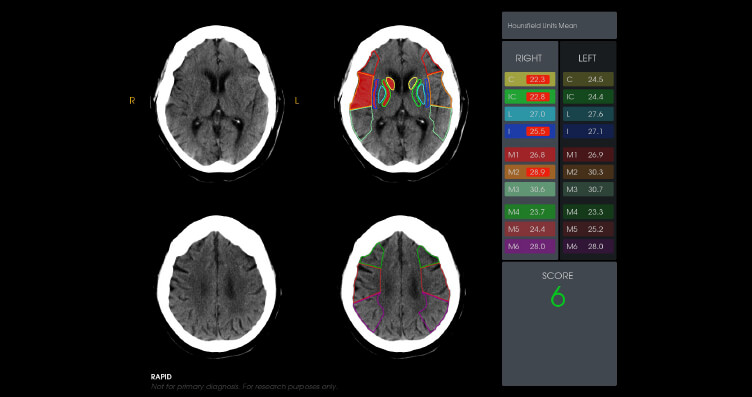 aspect-score-stroke-neuroimaging-device-rapid-aspects